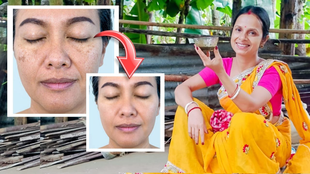 তুলসী পাতা দিয়ে এইভাবে মেছতার দাগ দূর করুন ১০০% গ্যারান্টি | how to reduce melasma permanently