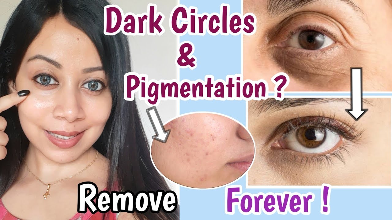 Remove Dark Circles & Pigmentation Forever!❤| Under eye Cream & Pigmentation Treatment on Face