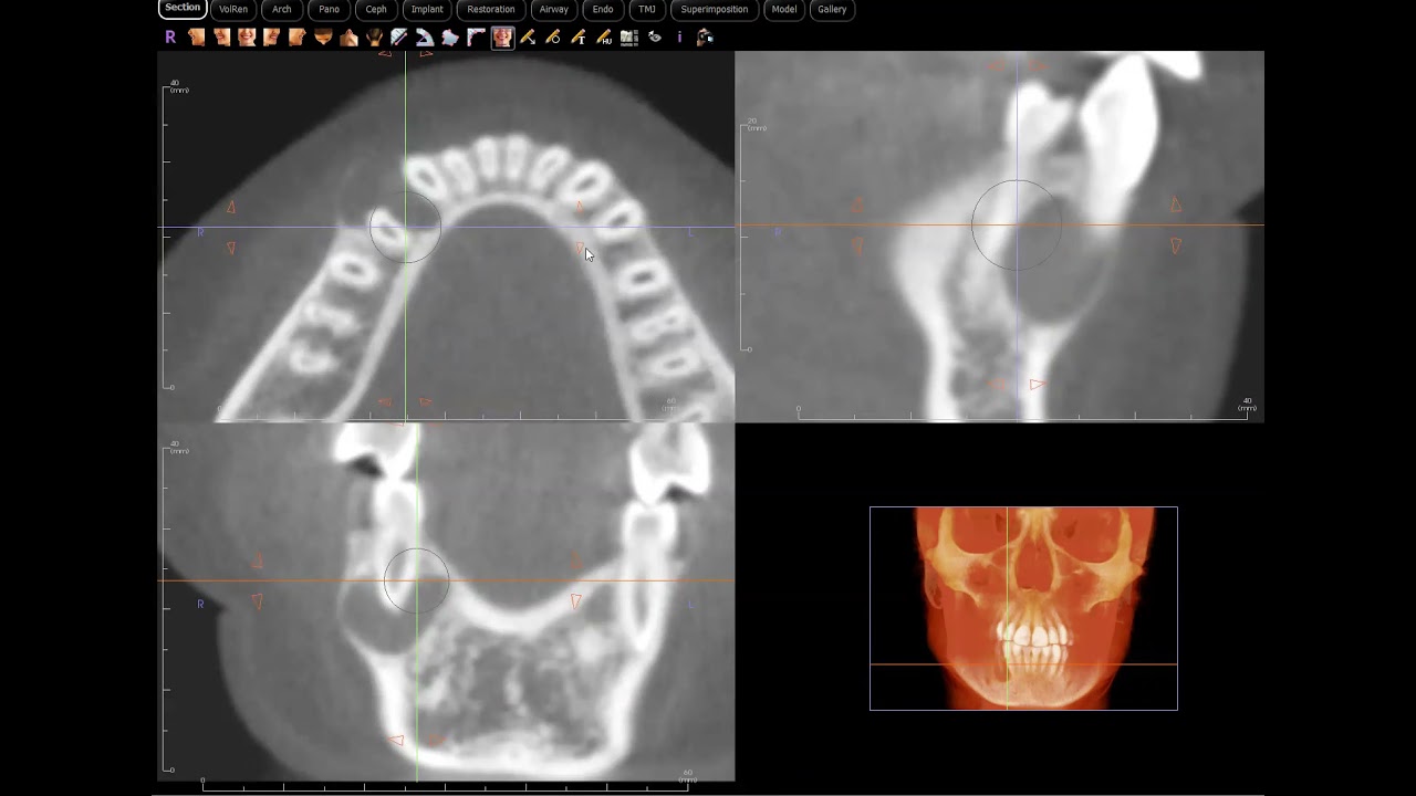 AOT, (Adenomatoid Odontogenic Tumor) confirmed!
