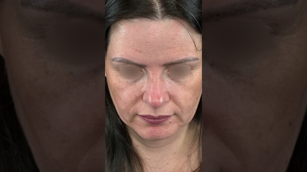 Antes e depois- Dr. Fábio Maniglia