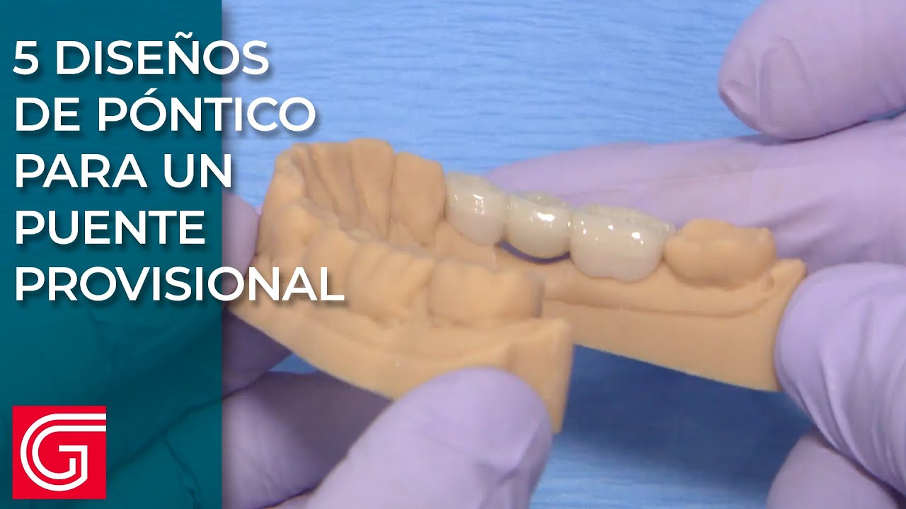 5 Diseños De Póntico Para Un Puente Provisional