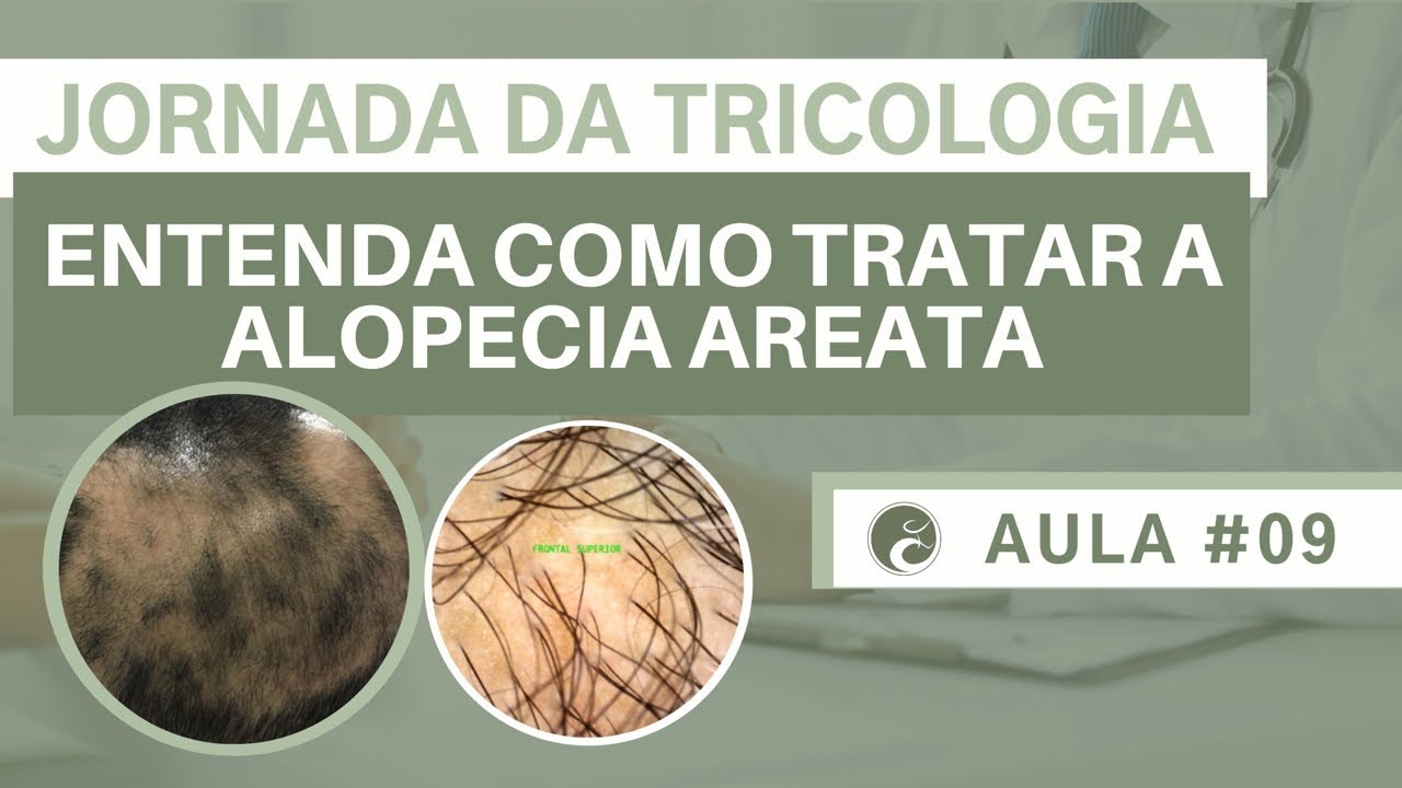 Alopecia Areata: Como Tratar e Recuperar os Fios? | Jornada da Tricologia #09