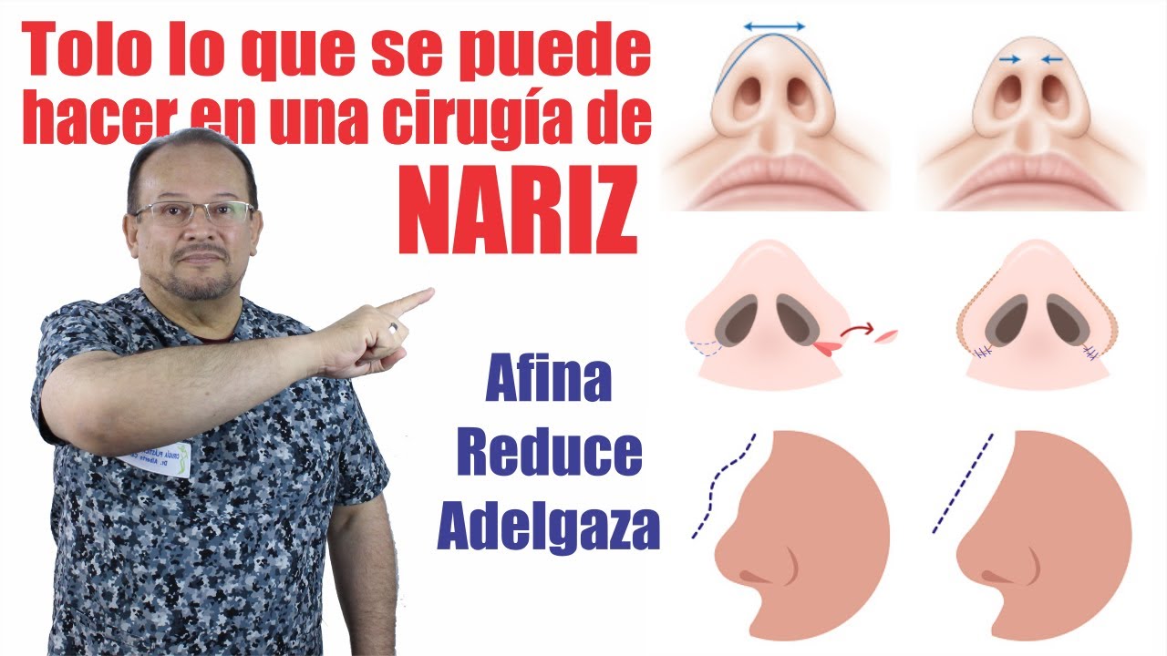 Que se puede HACER en una CIRUGÍA de NARIZ: alectomía gibectomía septoplastía etc 🤩 DR ALBERTO CALVO