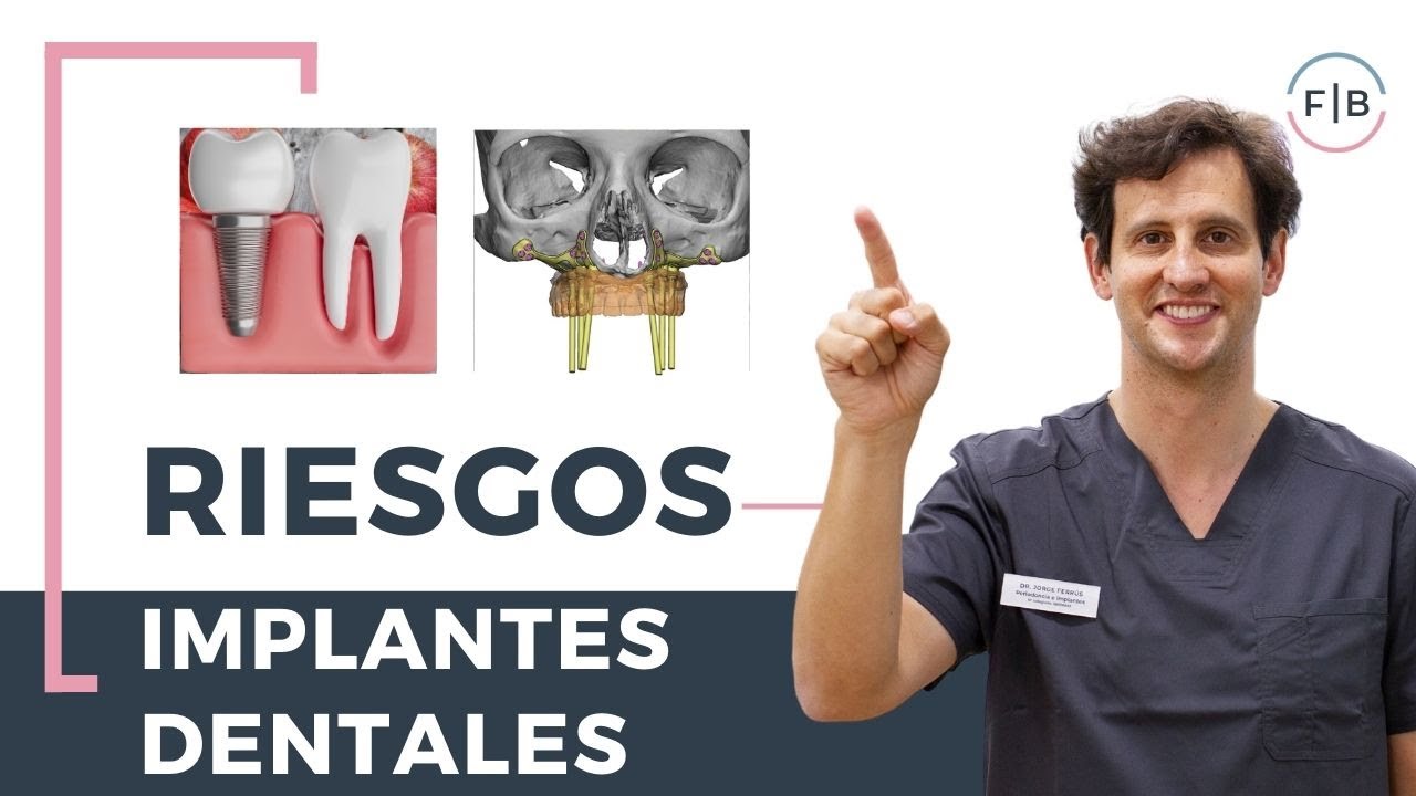 ¿Qué riesgos y complicaciones tienen los implantes dentales ? | Clínica dental Ferrus & Bratos