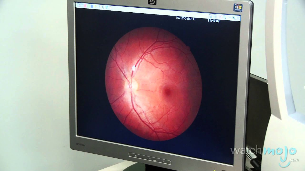 Diabetes Eye Exam: Test Against Early Blindness