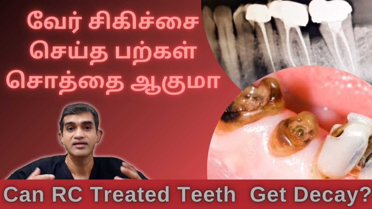 Decay after Root Canal Treatment | வேர் சிகிச்சை செய்த பற்கள் சொத்தை ஆகுமா | Dr Arunkumar Chennai