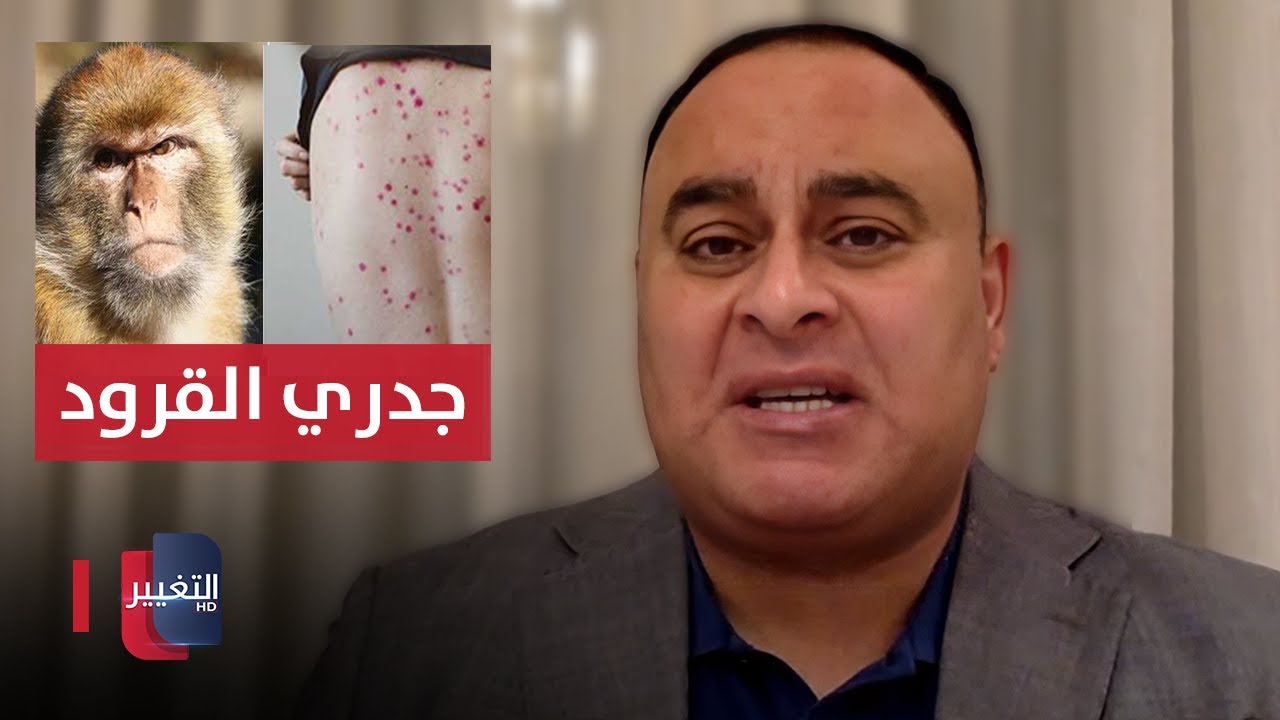 جدري القردة طرق العدوى كيفية انتقاله الى البشر