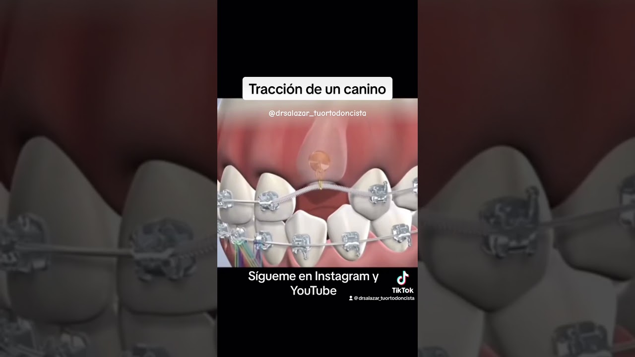 Tracci&oacute;n de canino incluido