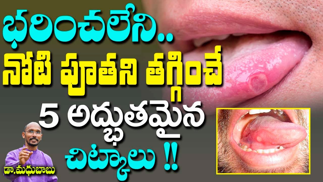 భరించలేని నోటి పూతని తగ్గించే 5 అద్భుతమైన చిట్కాలు !! | Dr. Madhu Babu | Health Trends |