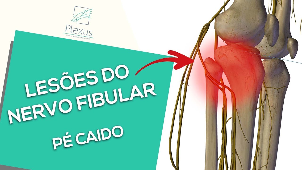 Lesões do nervo fibular
