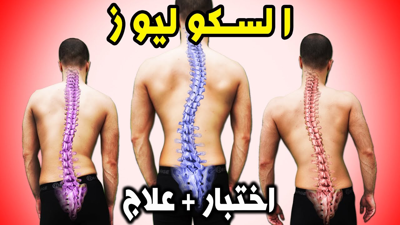 الجنف | علاج اعوجاج وانحراف العمود الفقري | ميلان الكتف | تمرين 5 دقائق في اليوم | scoliosis