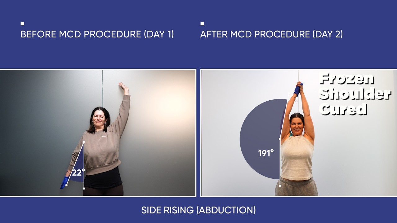 A Dentist’s Frozen Shoulder Story: 10 Failed Treatments, Recovery in 2 Days