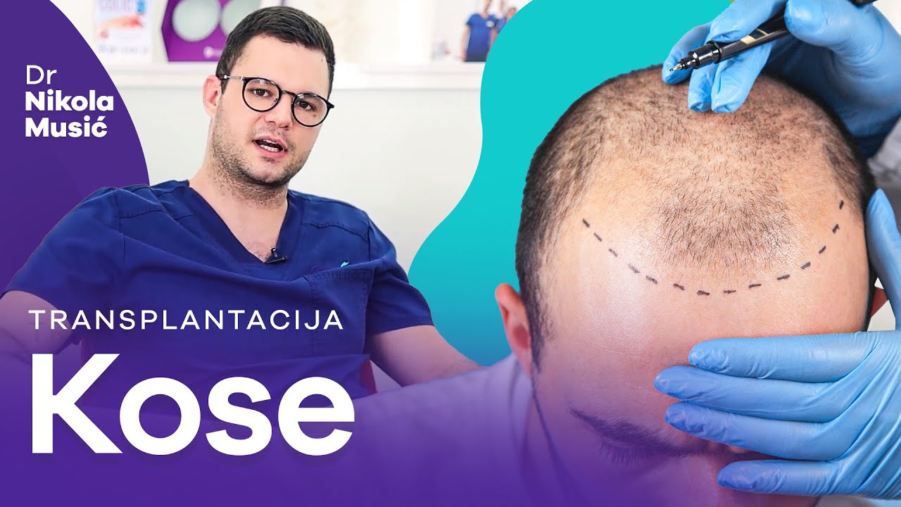 Transplatacija kose - koja metoda se koristi, ko su kandidati, kakav je oporavak i da li je uspešna?