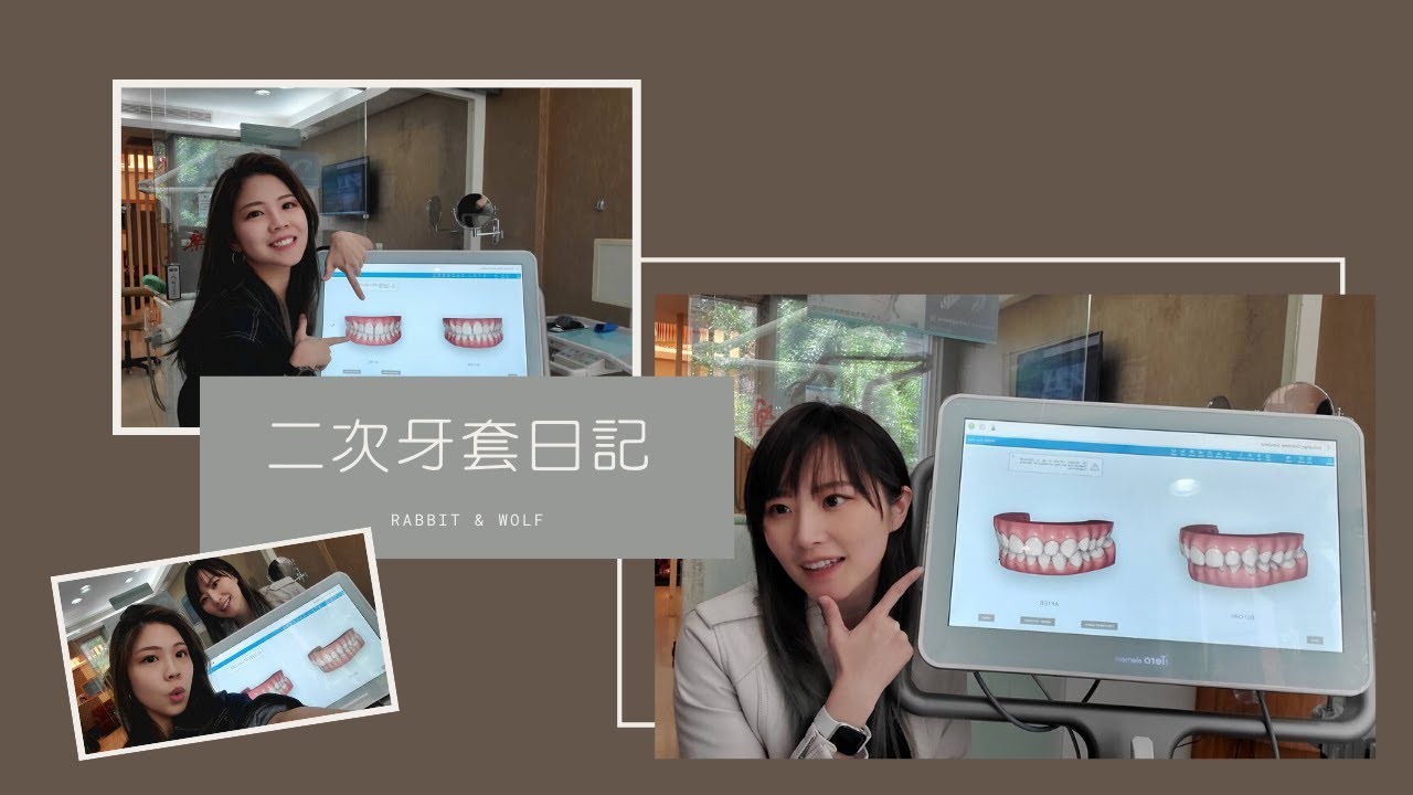 [Life]二次矯正隱適美諮詢｜牙套妻妻｜兔女狼