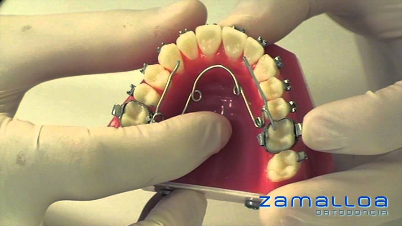 Quad helix en ortodoncia: en qué consiste | Ortodoncia Zamalloa