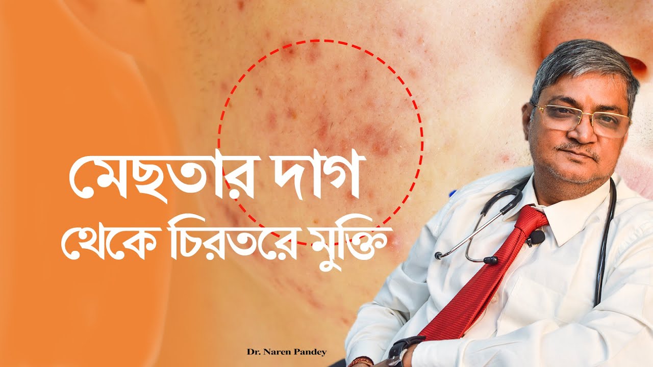 মেছতার দাগ থেকে চিরতরে মুক্তি | 100% Relive From Hyperpigmentation | Dr. Naren Pandey|
