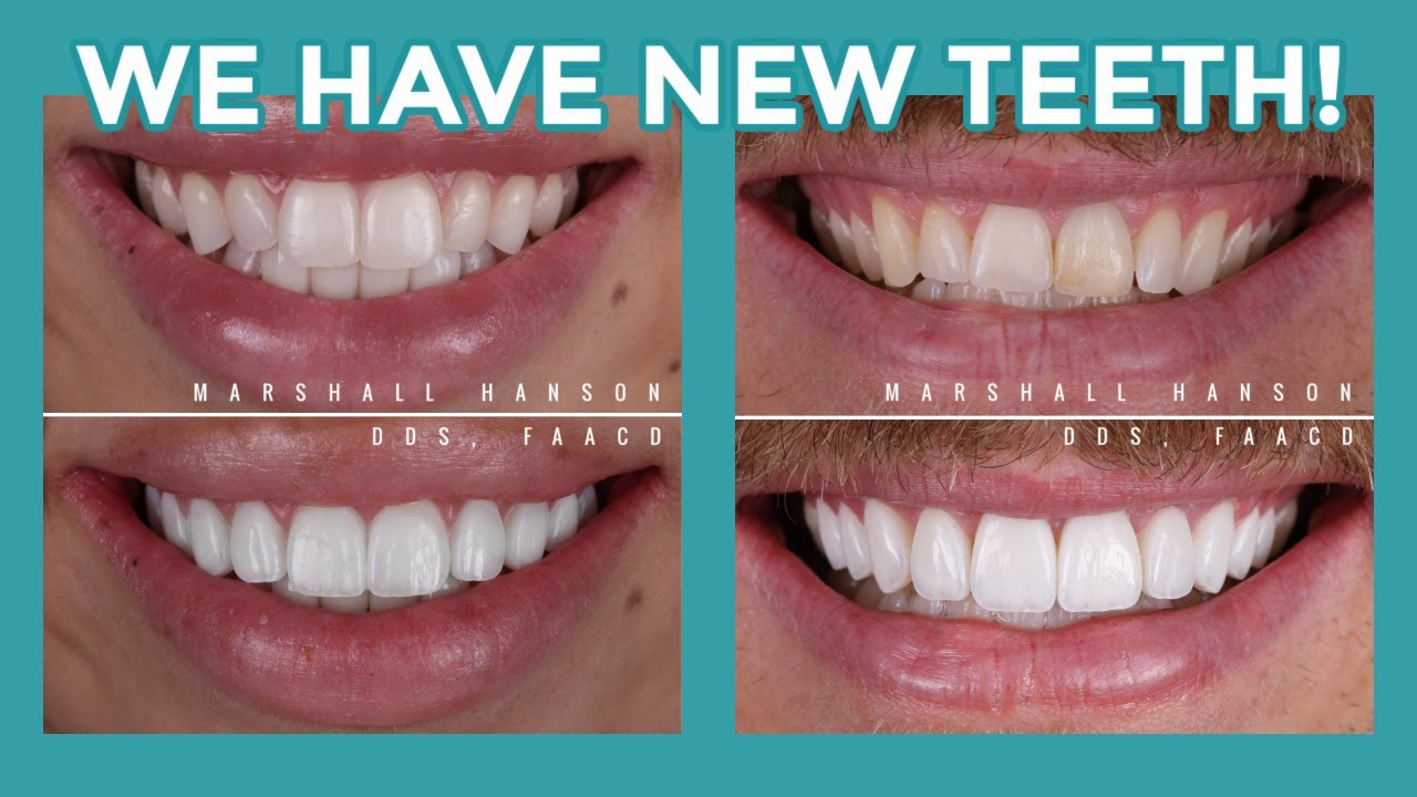 We Have New Teeth and They Aren't Veneers!