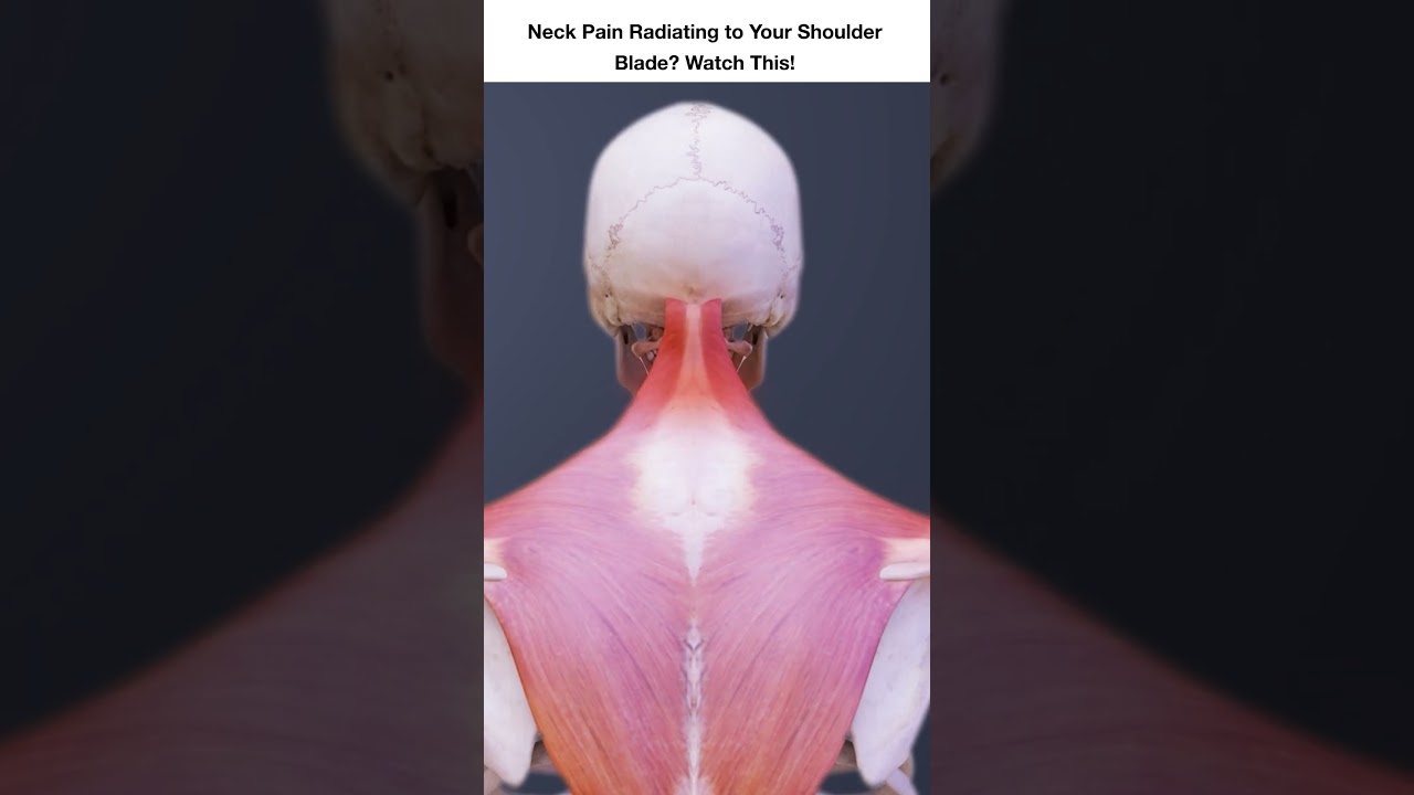 Neck Pain Radiating to Your Shoulder Blade? Watch This!