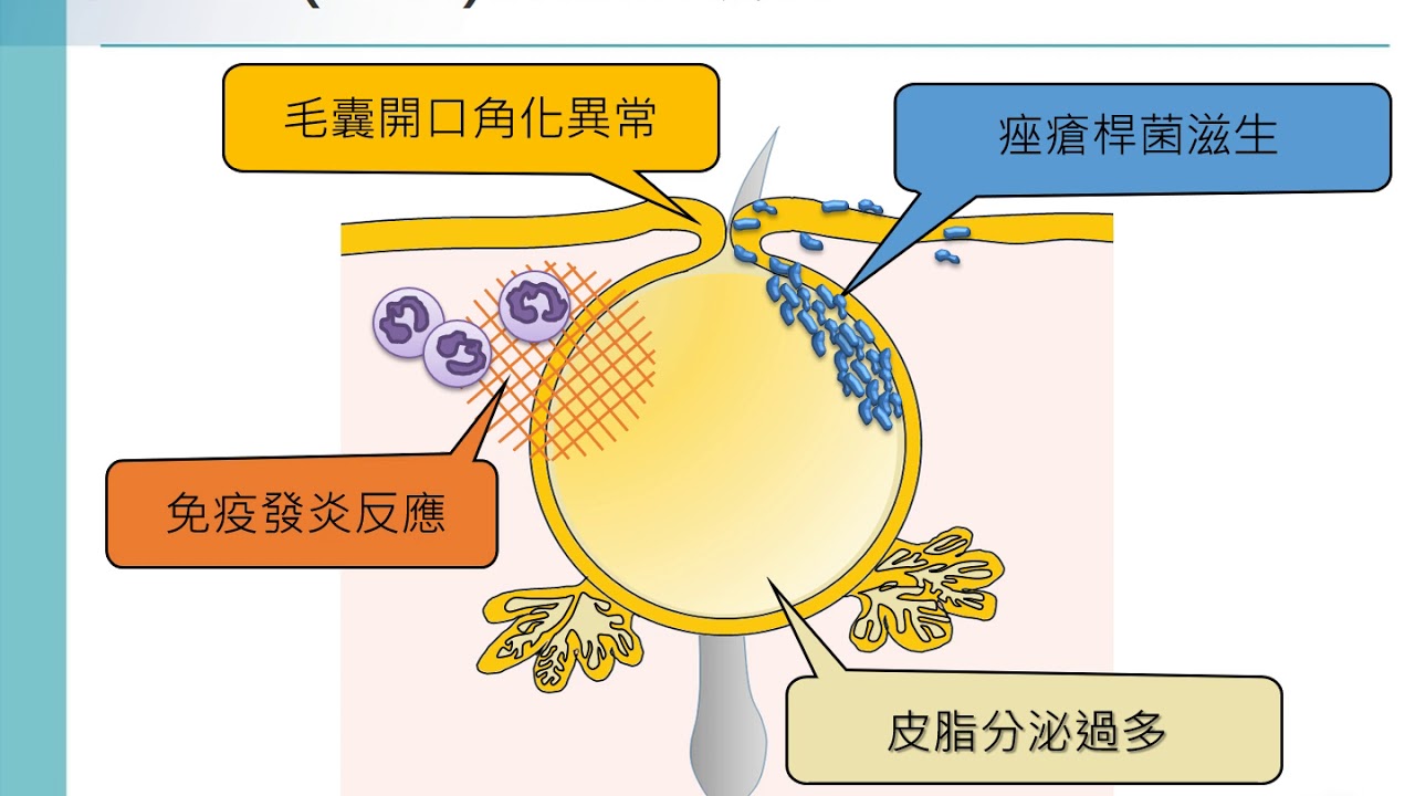 28 施怡賢醫師 青春痘痤瘡是洗臉沒洗乾淨造成的嗎