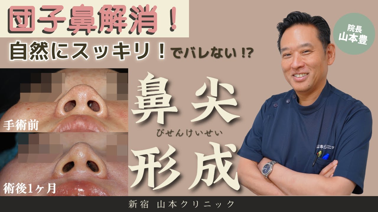 鼻先だけの手術（鼻尖形成術だけ）@山本クリニック #鼻整形　#美容外科 #鼻尖形成