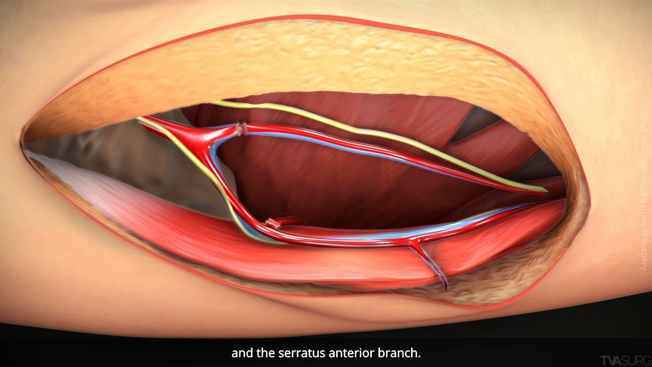 Thoracodorsal artery perforator flap harvest