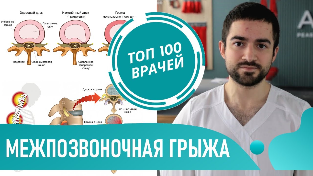 Грыжа пройдет сама? Межпозвоночная грыжа - симптомы и лечение. Резорбция грыжи