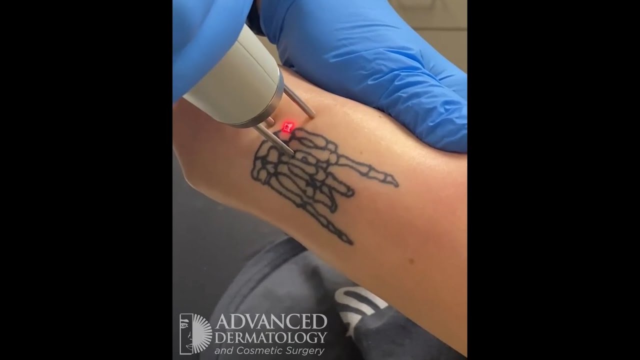 Tattoo removal at Advanced Dermatology and Cosmetic Surgery