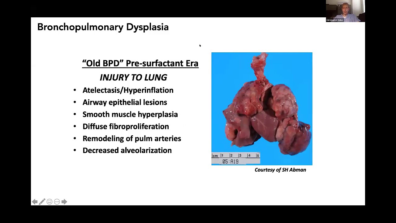 Virtual FTS Pediatric Session: Bronchopulmonary Dysplasia