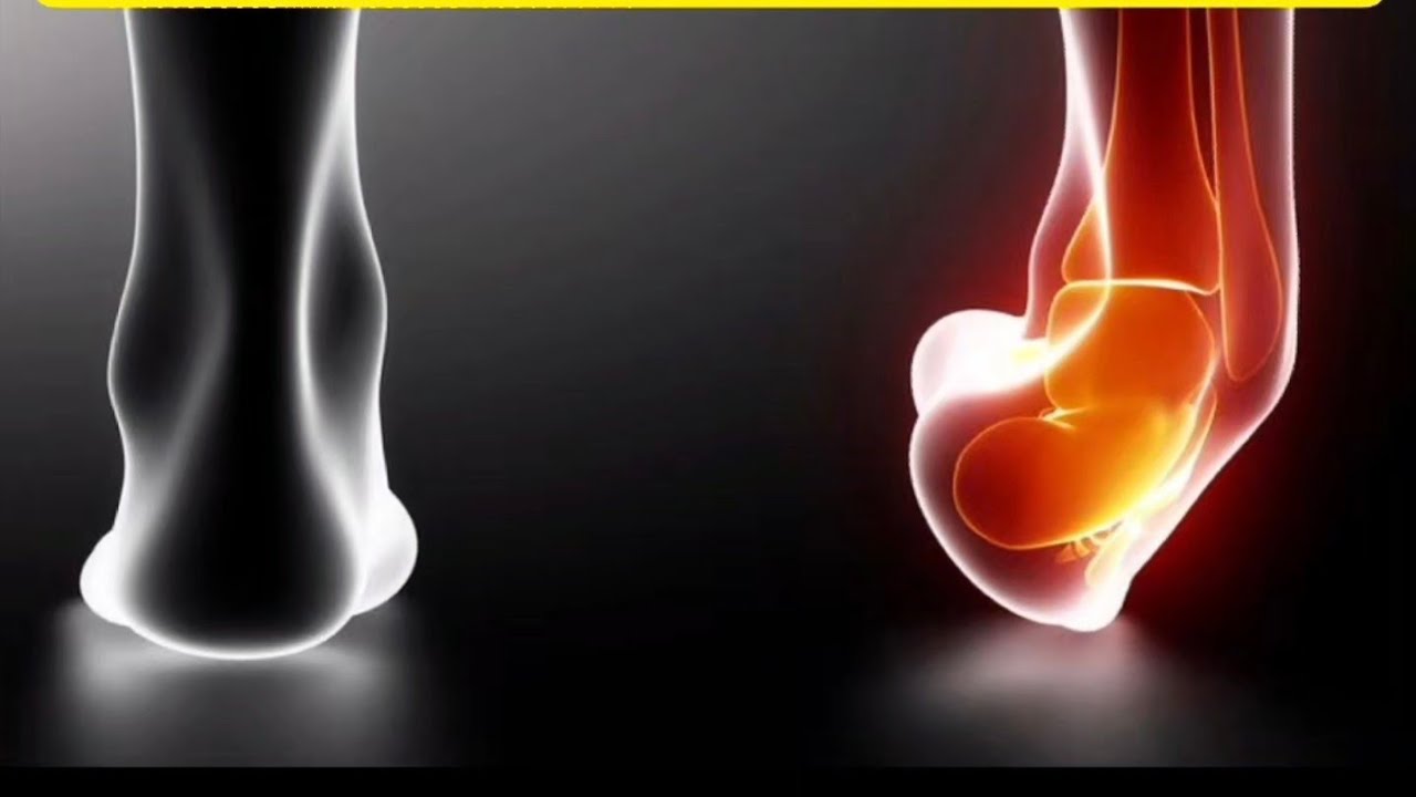 تأهيل التواء الكاحل من أول يوم إلى العودة للملاعب