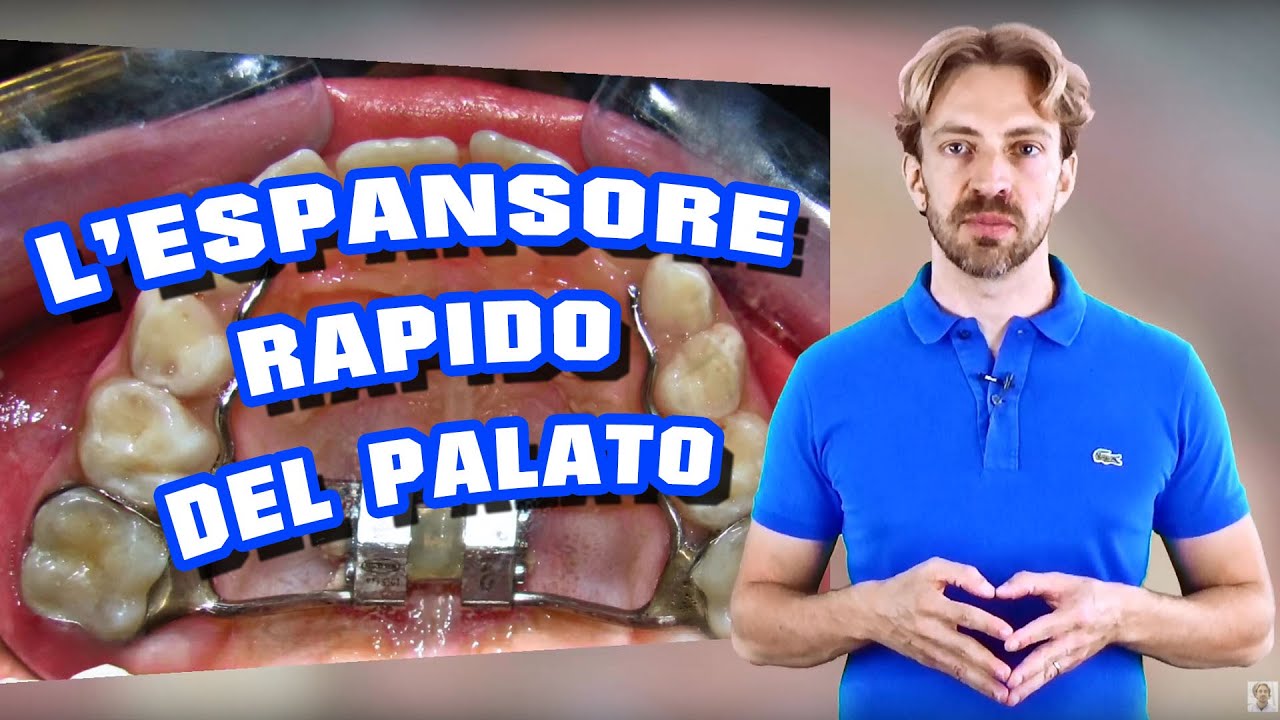 L' Espansore Rapido del Palato