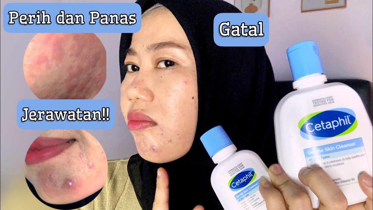 REVIEW CETAPHIL GENTLE SKIN CLEANSER 3 BULAN PAKAI || BREAKOUT DONG!!