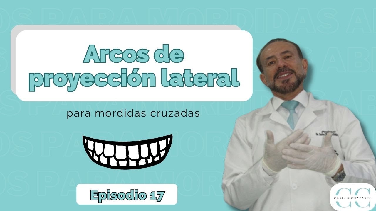 ✅ Arcos de proyección lateral para mordidas cruzadas - Episodio 17
