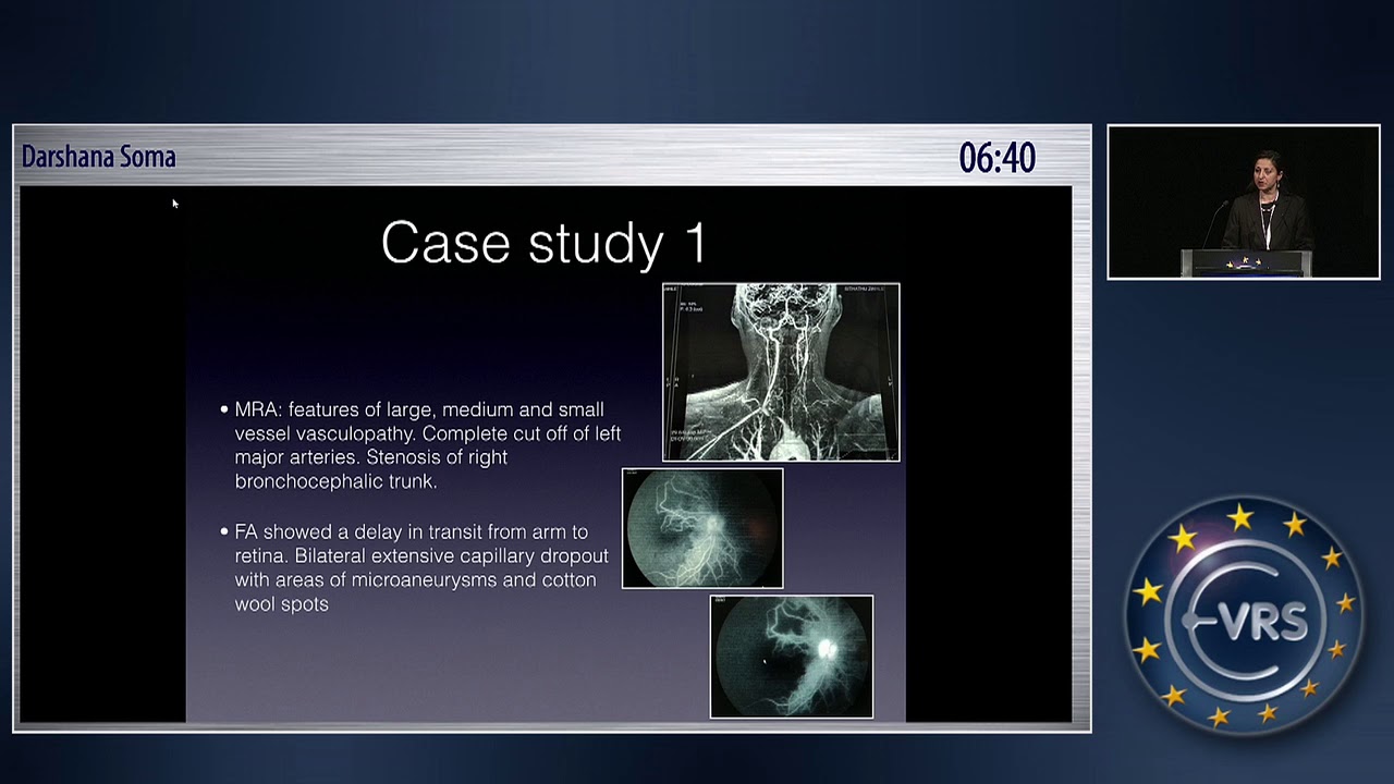 Ocular and Neurologic Manifestations of Takayasu Arteritis