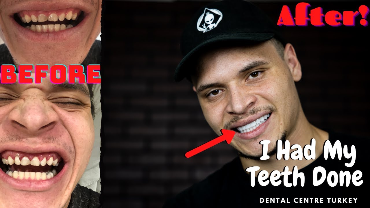 I Had My Teeth Done Overseas (Dental Centre Turkey) *Honest Experience