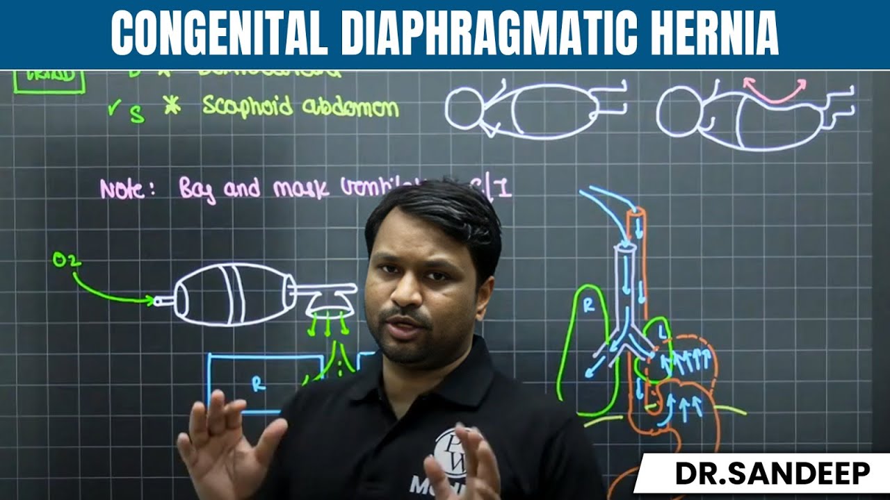 Congenital Diaphragmatic Hernia | Surgery | Bailey learned with Dr. Sandeep