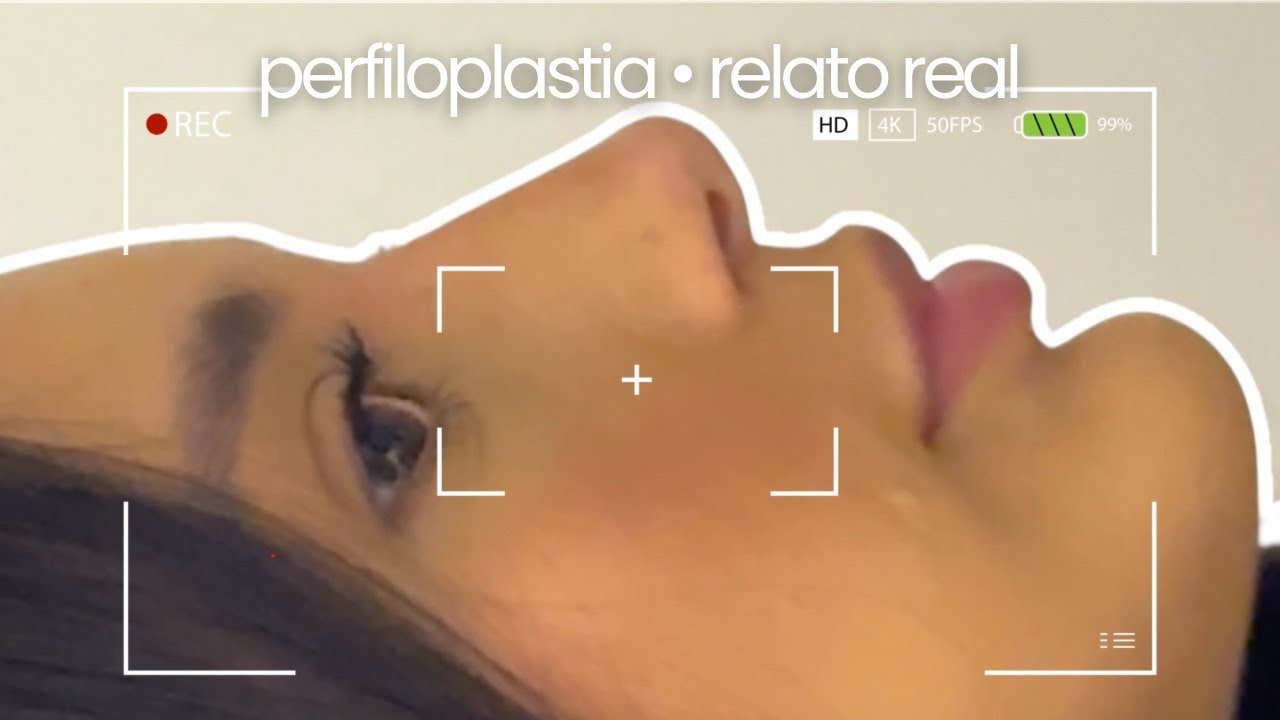 minha experiência com a perfiloplastia | processo + resultado