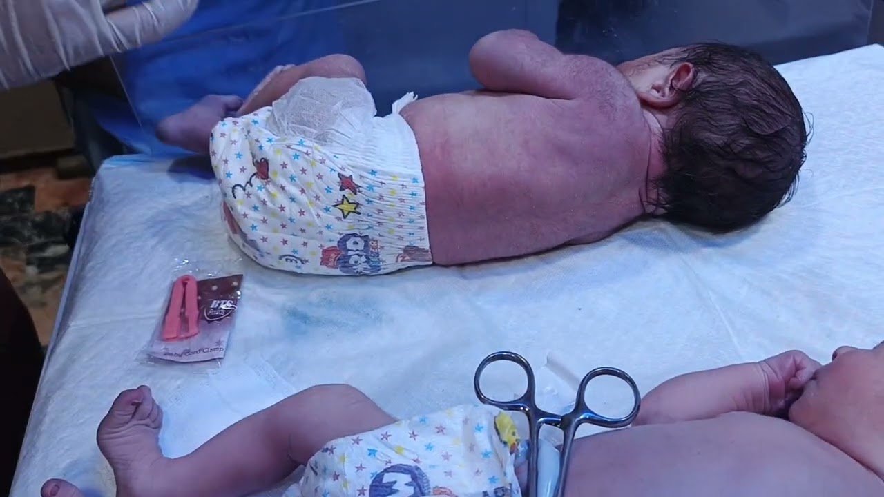 First Umbilical Cord Procedure of Cute Twin Newborn Babies 👶👶✨