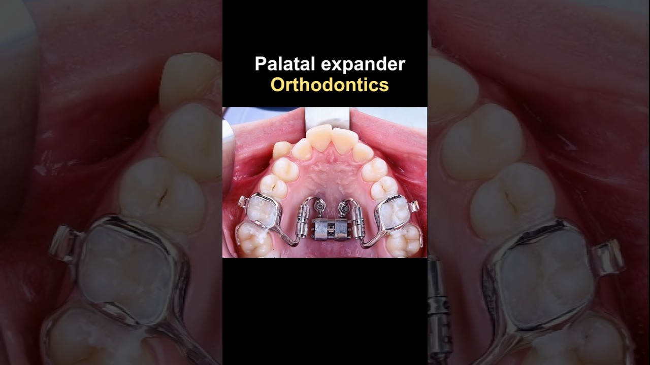 Expander jaw when orthodontics #braces #orthodontist #dentist