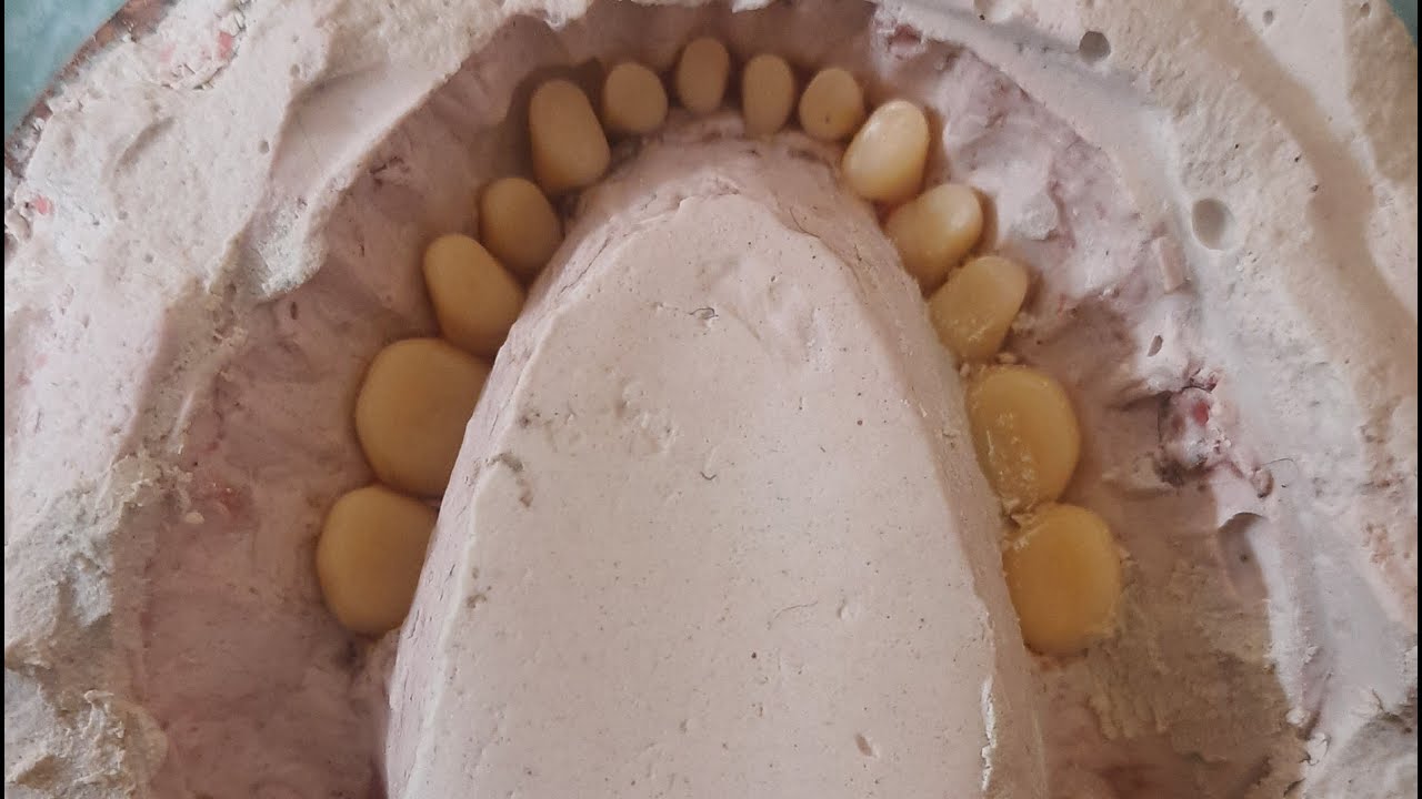 Flasking and Dewaxing of Complete Denture | Complete Denture #8 | Prosthodontics