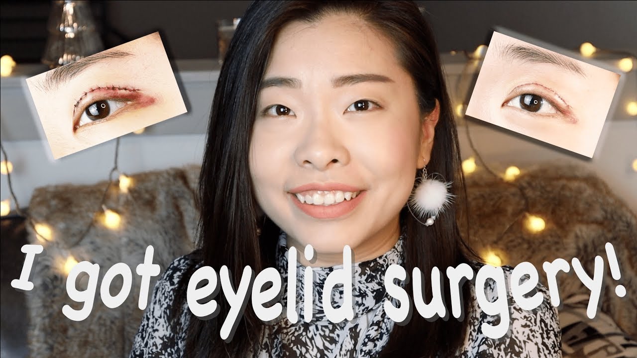 MEDICALLY REQUIRED DOUBLE EYELID SURGERY?! | Watch My Recovery