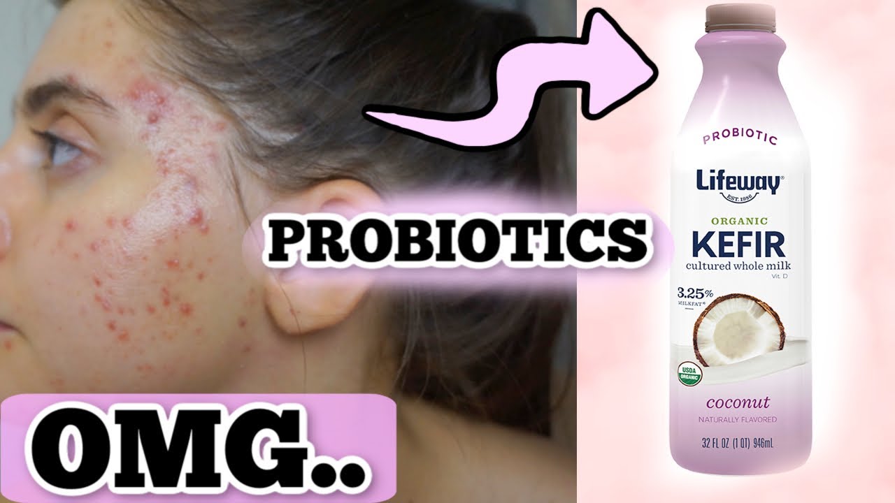 I TRIED PURE PROBIOTIC COCONUT KEFIR FOR ONE WEEK || THIS IS WHAT HAPPENED TO MY ACNE...