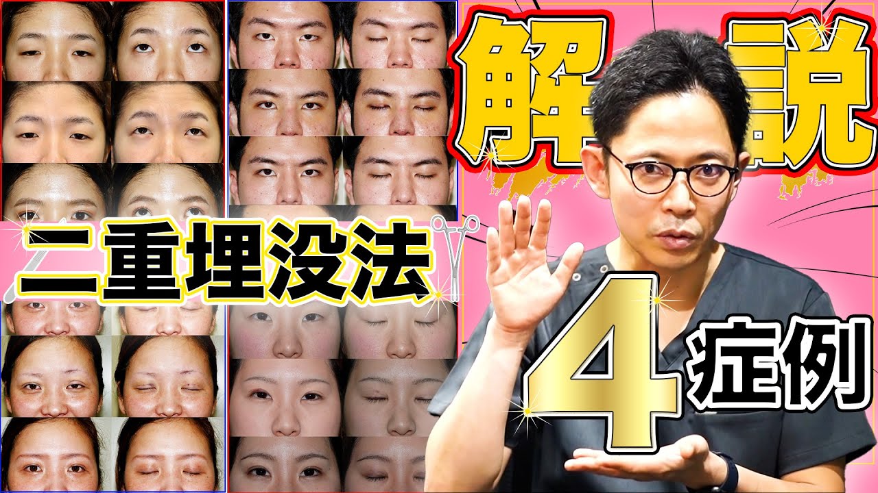 【目の整形】「二重埋没法」症例解説