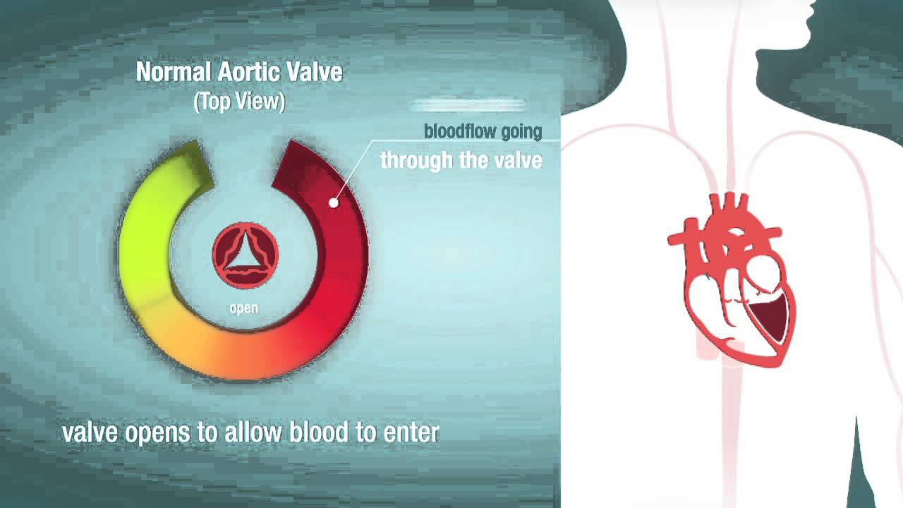 Valve Stenosis: When a Heart Valve is Too Narrow