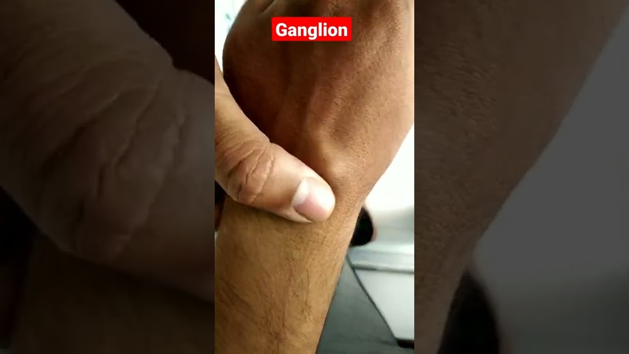 Ganglion Cyst Wrist Diagnosis #shorts