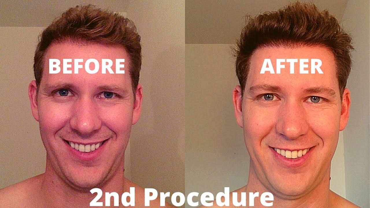 Second Procedure: One Year Post-Op and Final Result! (11/11/2016)
