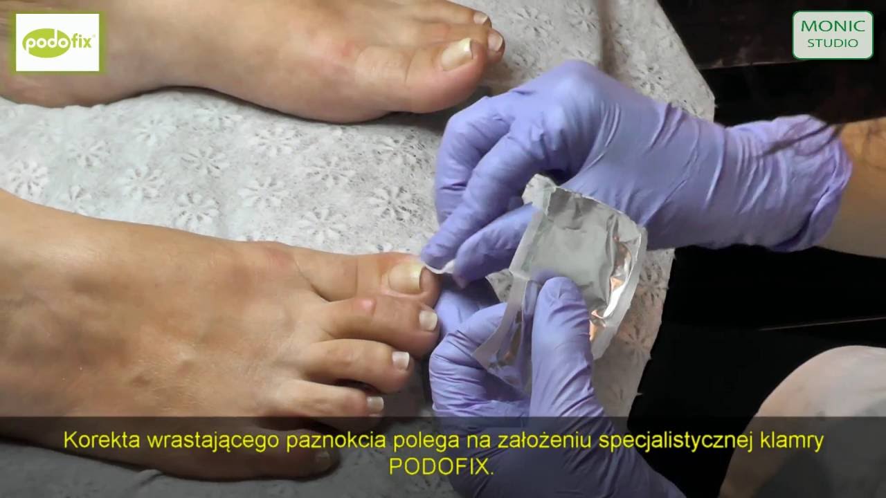 WRASTAJĄCE PAZNOKCIE, PEDICURE LECZNICZY W MONIC STUDIO
