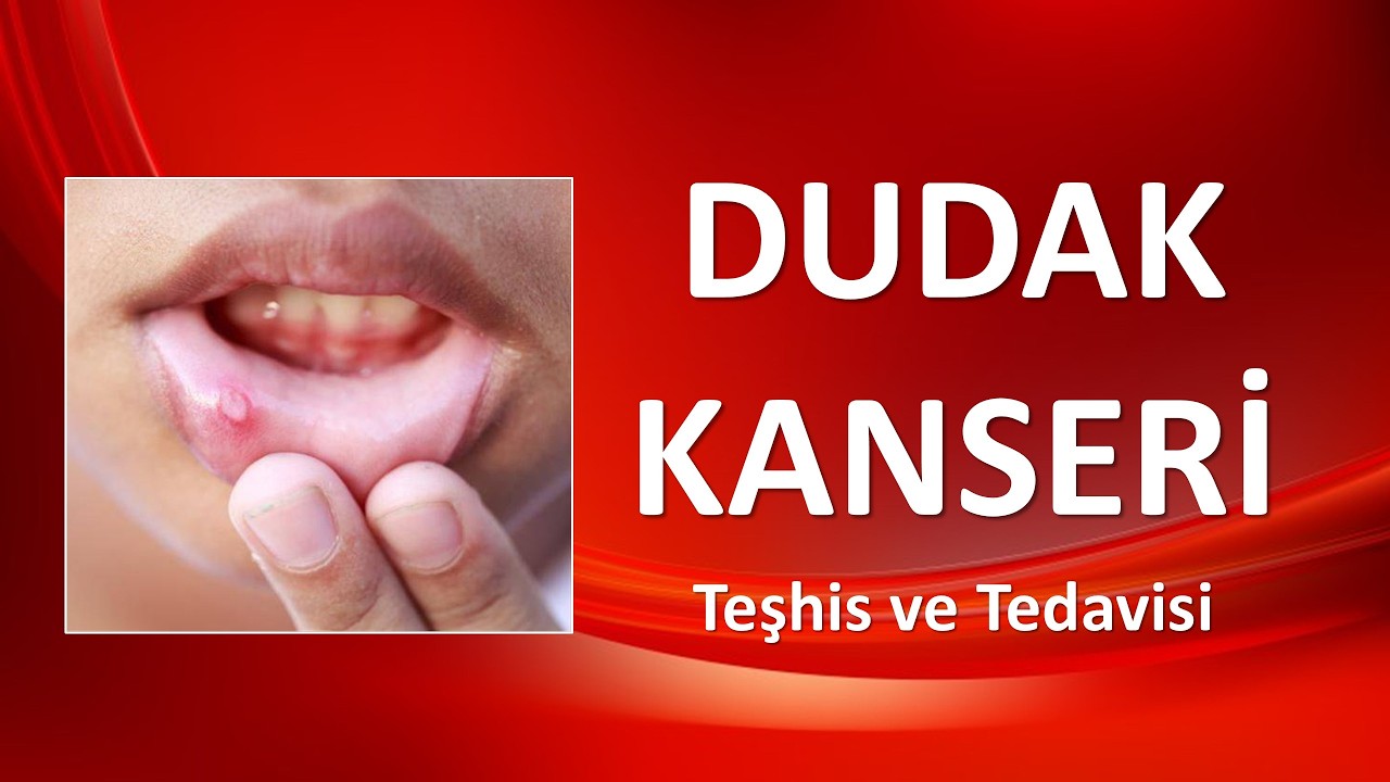 DUDAK KANSERİ Teşhis ve Tedavisi