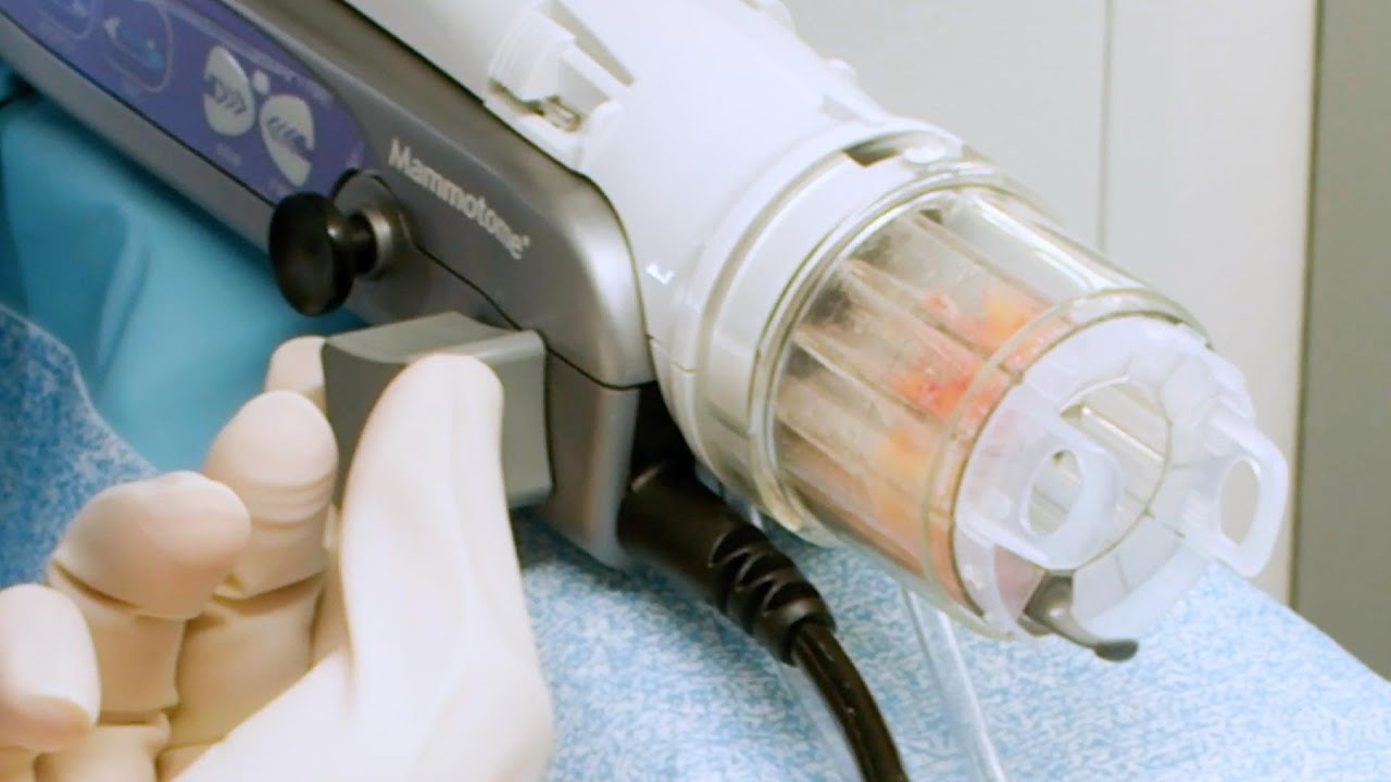 Mammotome Revolve™ Stereotactic Biopsy Procedure
