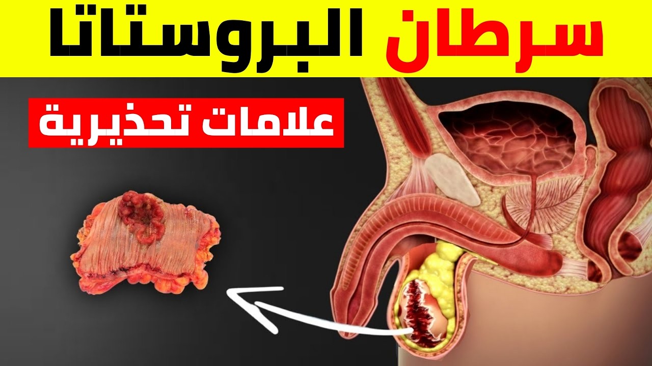 13 علامة مبكرة وصامتة لسرطان البروستاتا (لا تتجاهلها) | أعراض سرطان البروستاتا