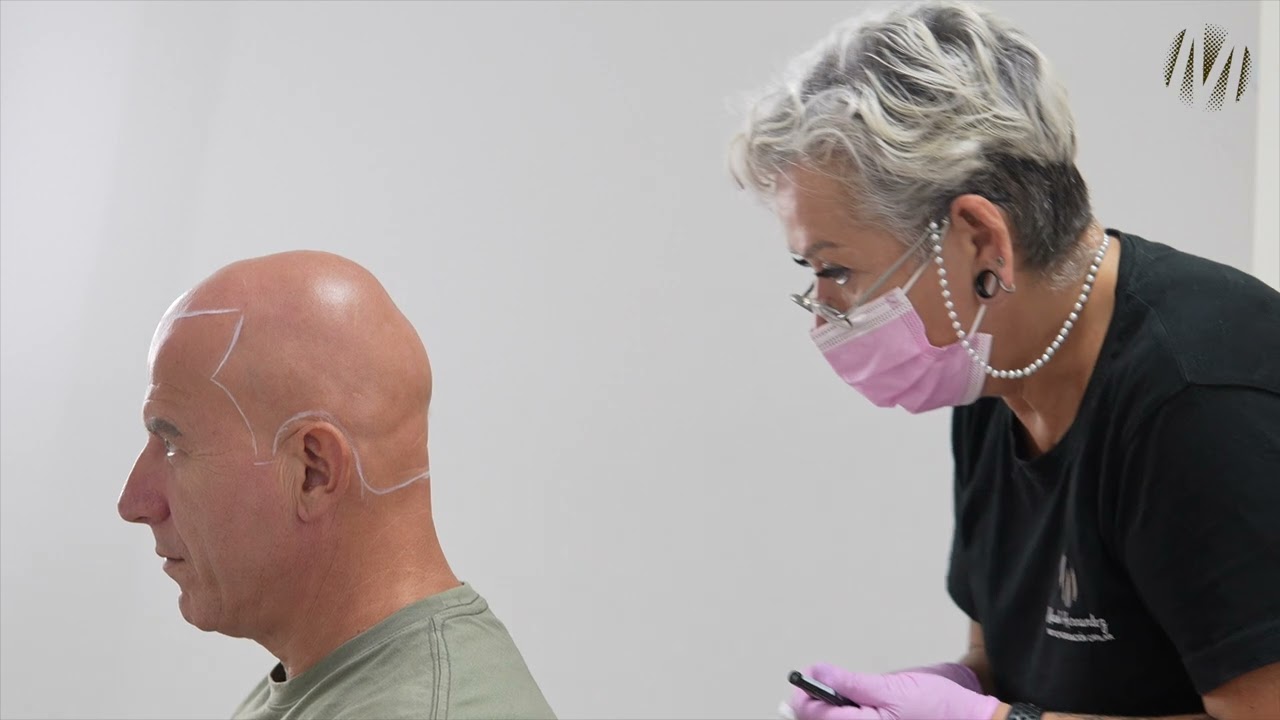 ¿Cómo es una micropigmentación capilar en una alopecia universal? | Manoli Hernández